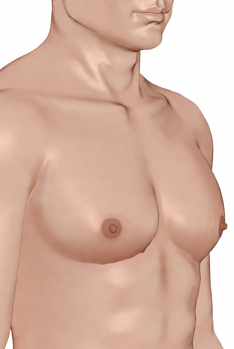 Gynecomastia Surgery ( Before )